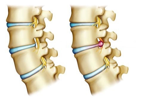 disc herniation surgery disc herniation surgery