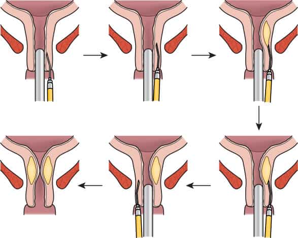 Hydorgel treatment of involuntary urination in women Hydorgel treatment of involuntary urination in women