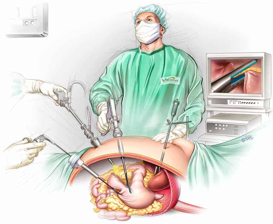 sleeve gastrectomy atlas hospital sleeve gastrectomy atlas hospital