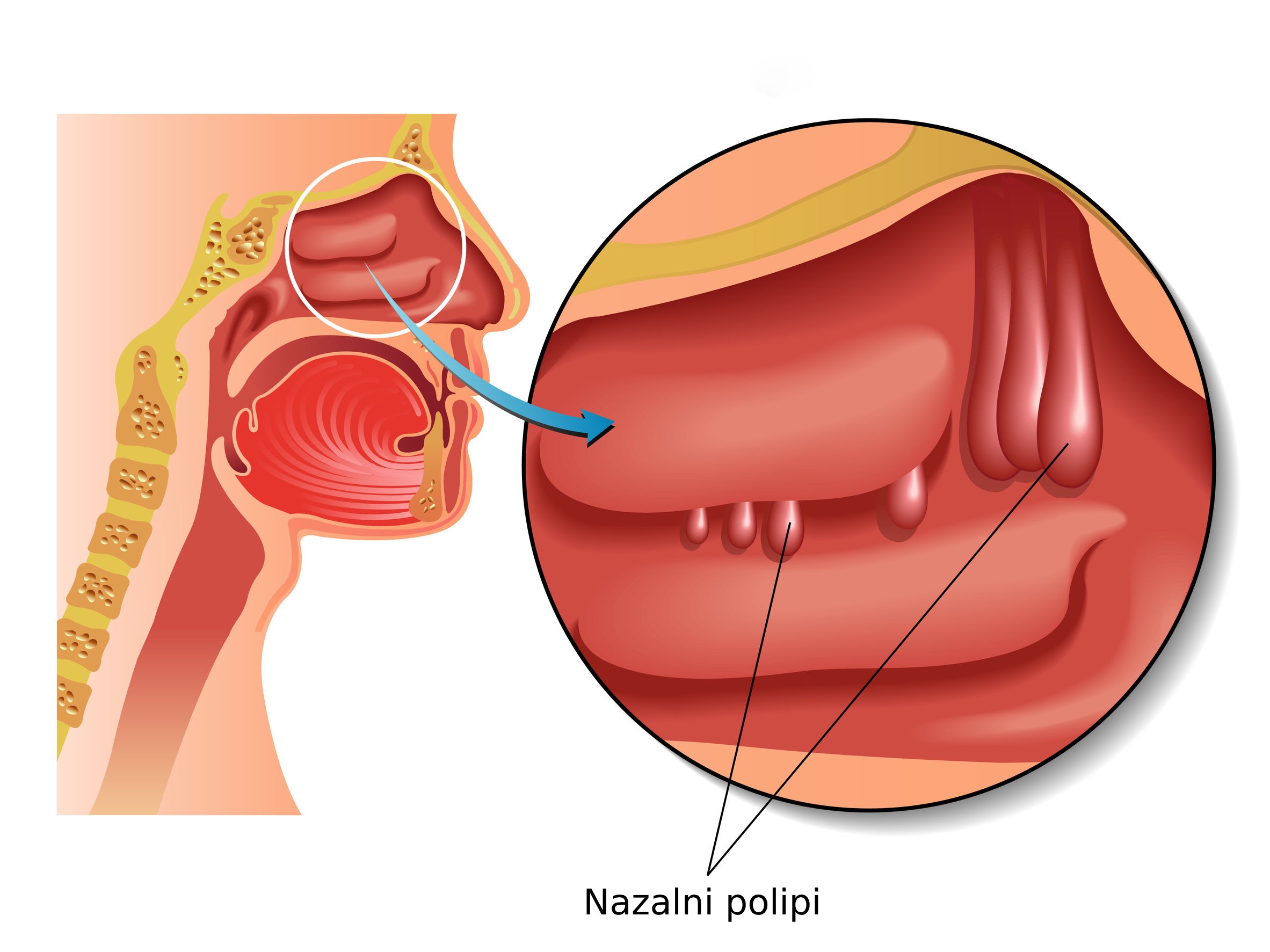Nasal polyps Nasal polyps