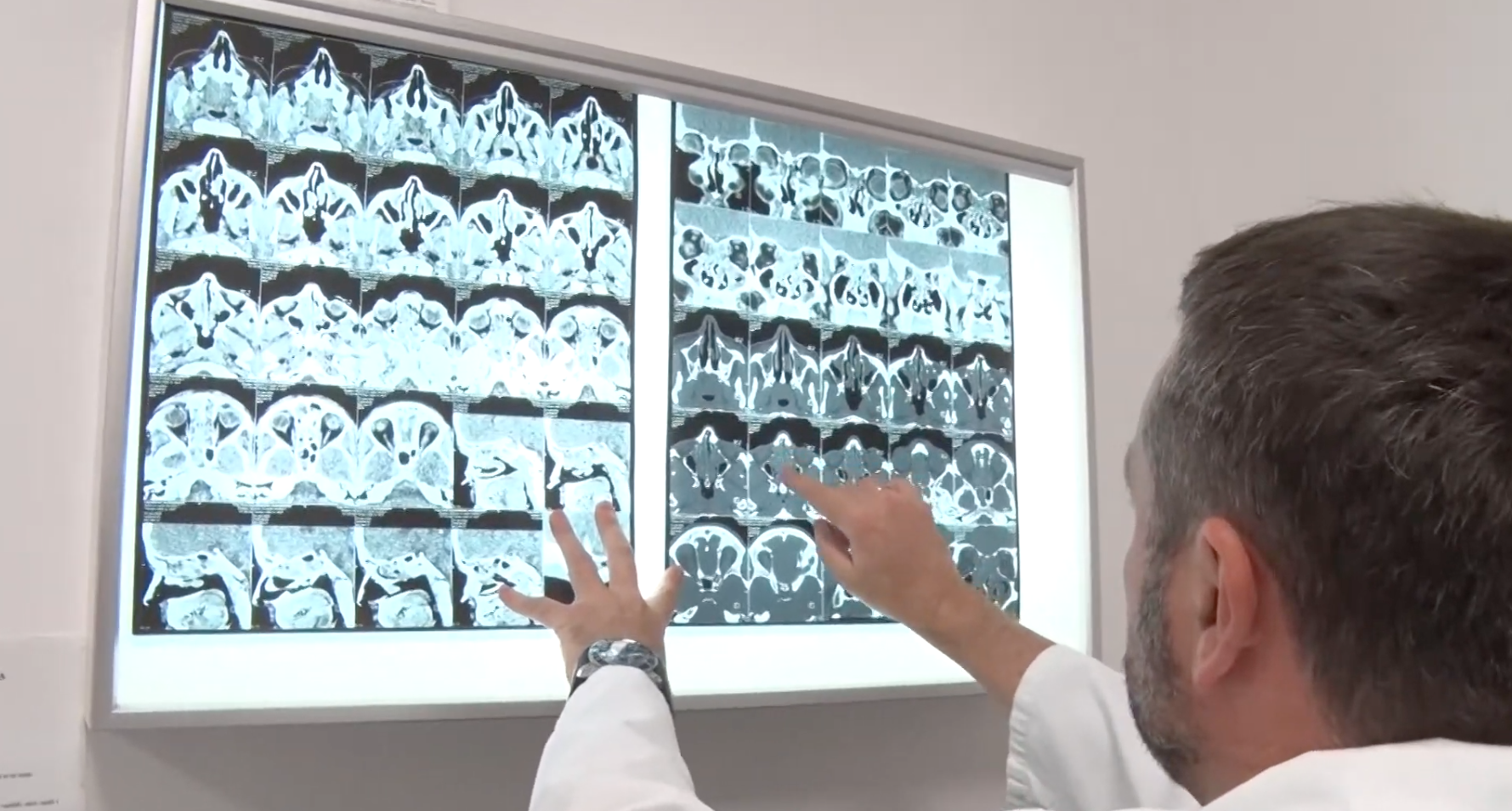 Nasal polyps Nasal polyps