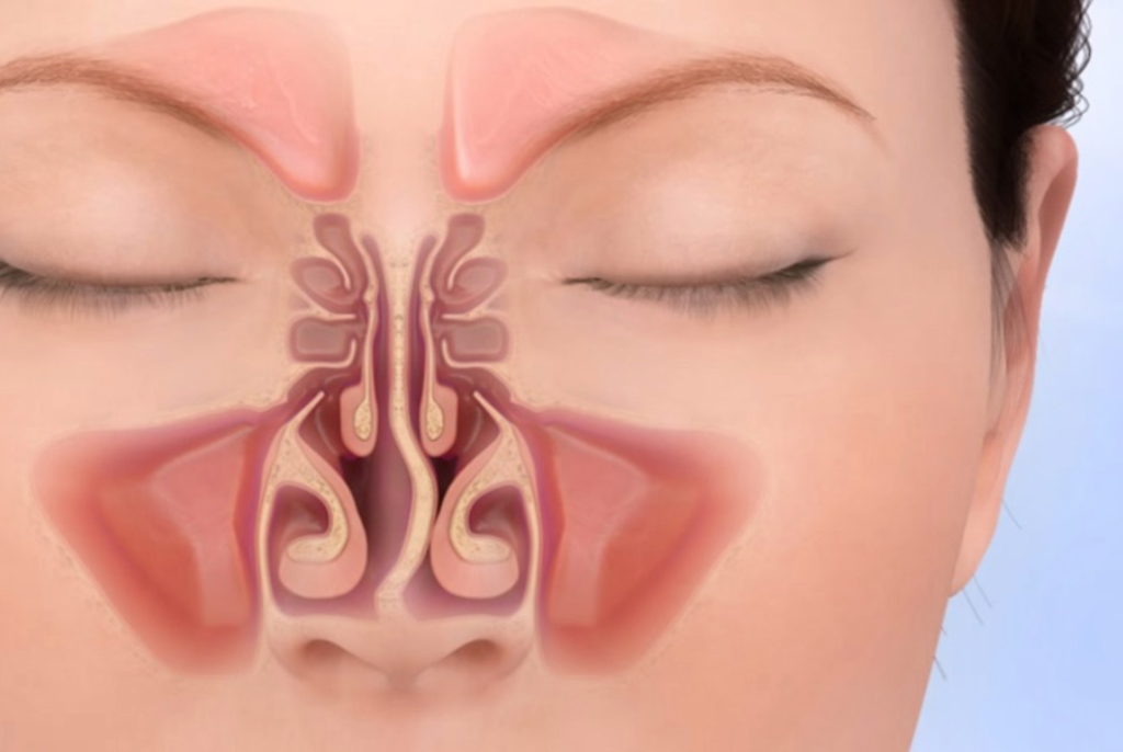 Iskrivljeni septum 