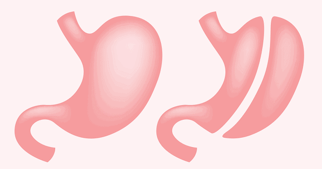 Sleeve gastrectomy