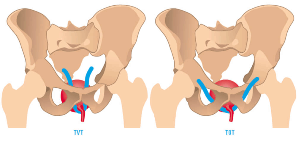 stress urinary incontinence TOT and TVT stress urinary incontinence TOT and TVT