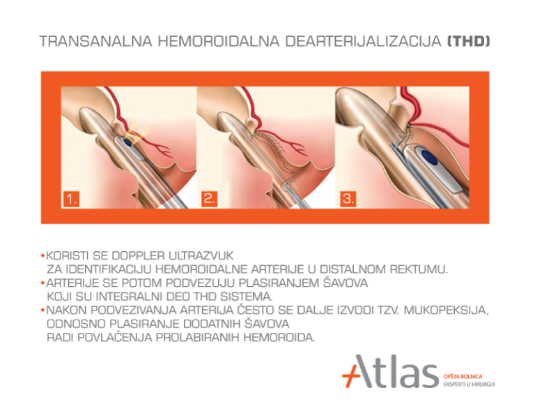 THD - hemorrhoids THD - hemorrhoids