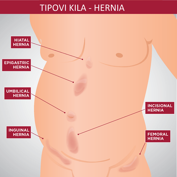 Tipovi kile