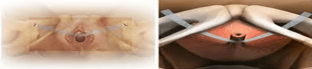 TOT for stress urinary incontinence TOT for stress urinary incontinence