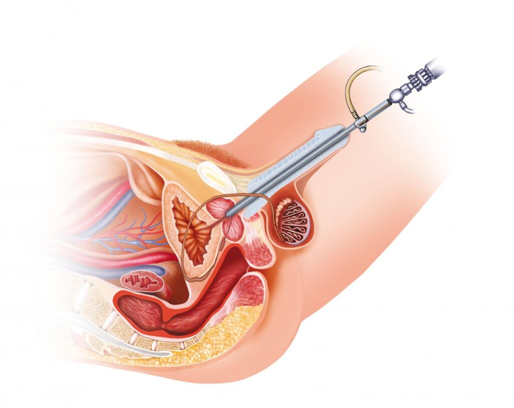 Bladder cancer surgery