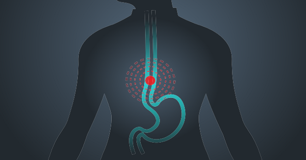 Esophageal cancer