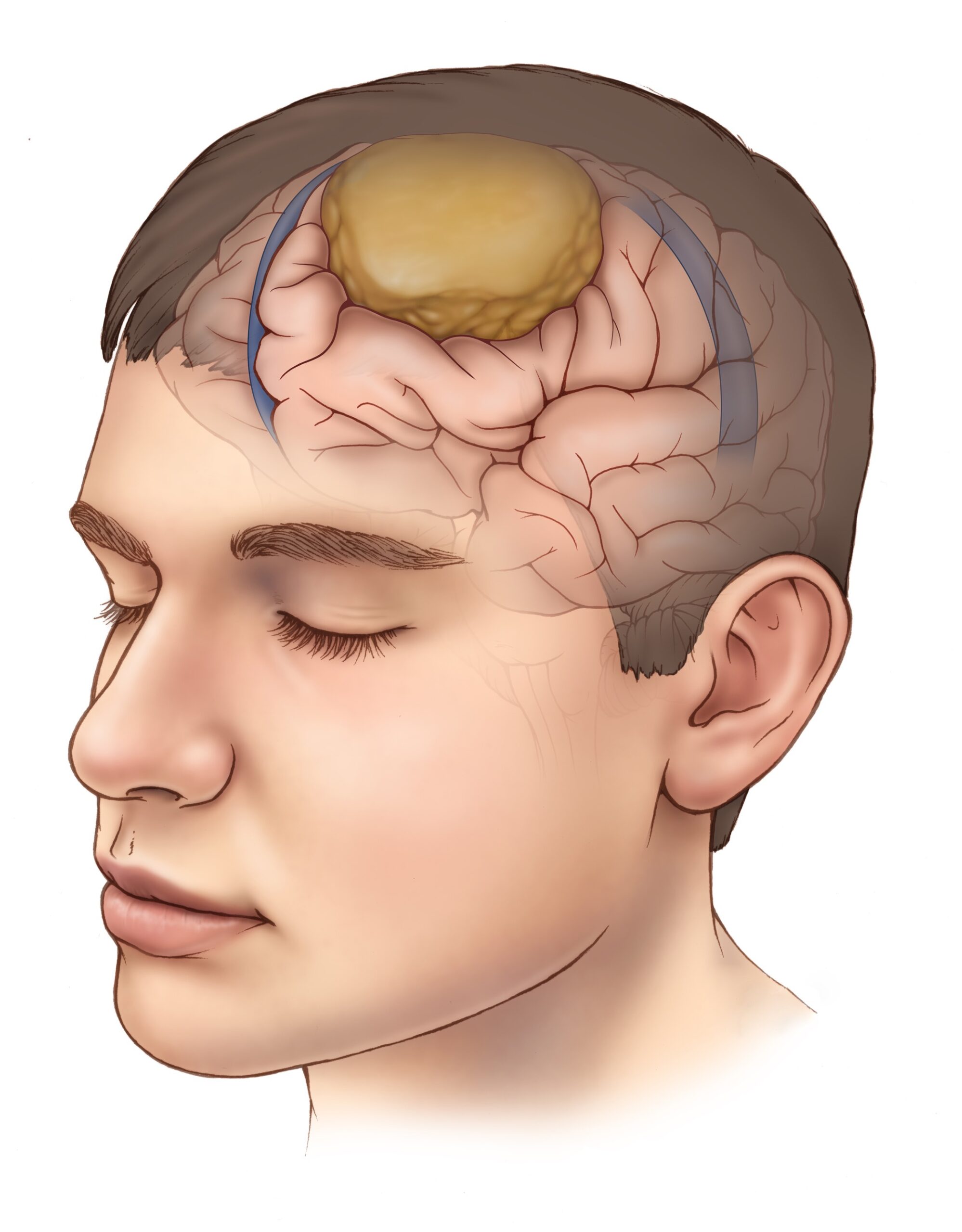 brain cancer brain cancer