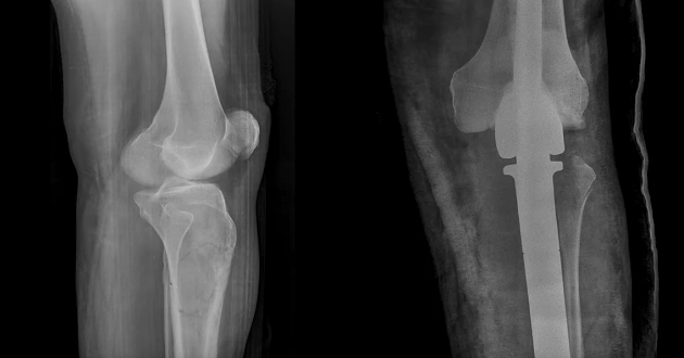 Invasive surgery for tumor of the lower leg