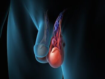 varicocele varicocele