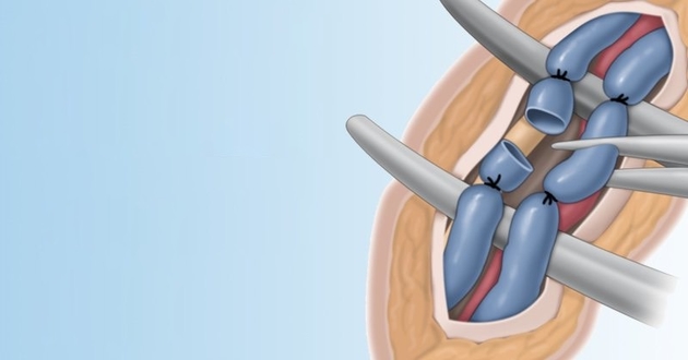 How to treat varicocele – enlargement of the venous plexus in the scrotum