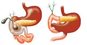 Cephalic duodenopancreatectomy (Whipple's procedure) Cephalic duodenopancreatectomy (Whipple's procedure)