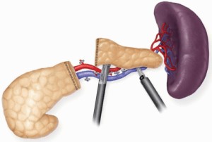 Distal pancreatectomy with splenic preservation