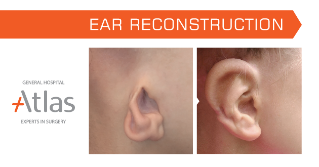 Ear reconstruction Ear reconstruction