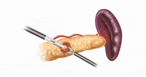 Enucleation of pancreatic tumor
