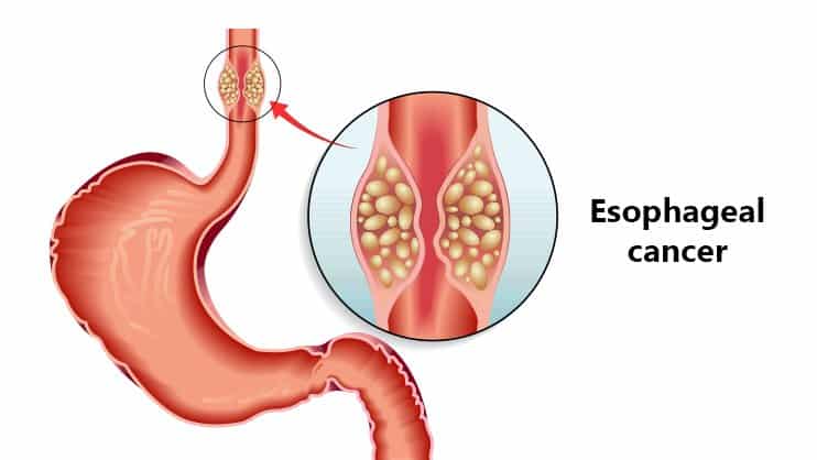 esophageal-cancer Atlas hospital esophageal-cancer Atlas hospital