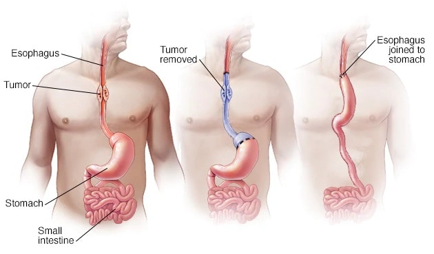 esophageal cancer surgery esophageal cancer surgery